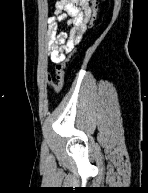 Bilateral ovarian teratoma (Radiopaedia 83131-97503 D 93).jpg