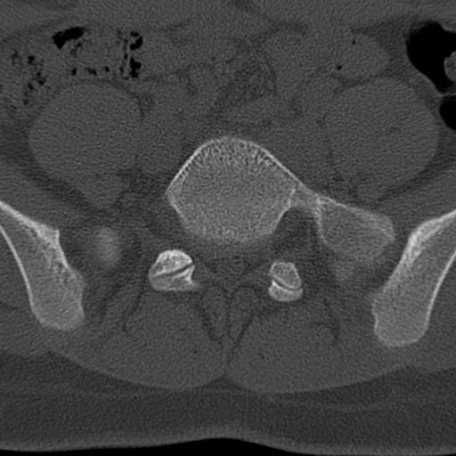 Bilateral pars defect (Radiopaedia 26691-26846 Axial bone window 65).jpg