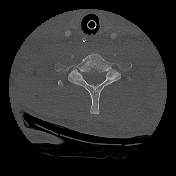 File:Bilateral perched facets with cord injury (Radiopaedia 45587-49713 Axial bone window 85).jpg