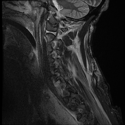 File:Bilateral perched facets with cord injury (Radiopaedia 45587-49714 Sagittal STIR 13).jpg