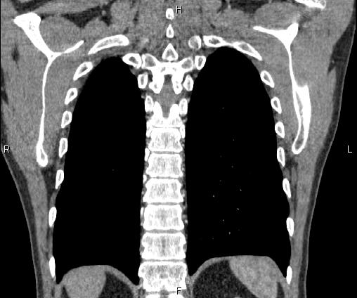 Bilateral pulmonary AVM (Radiopaedia 83134-97505 C 60).jpg