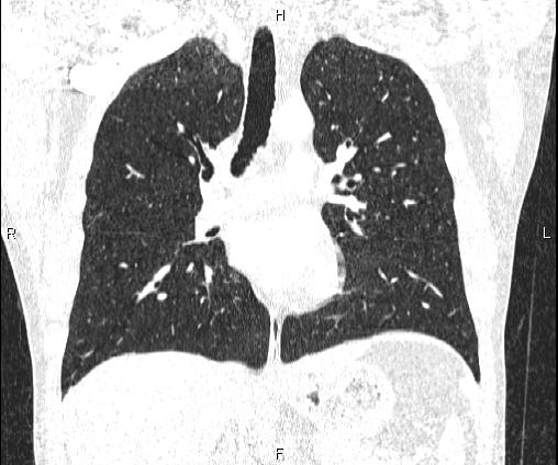 Bilateral pulmonary AVM (Radiopaedia 83134-97505 Coronal lung window 44).jpg