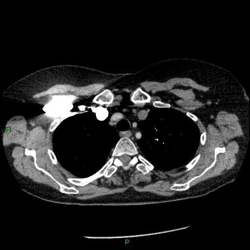 File:Bilateral pulmonary emboli (Radiopaedia 32700-33669 Axial C+ CTPA 19).jpg