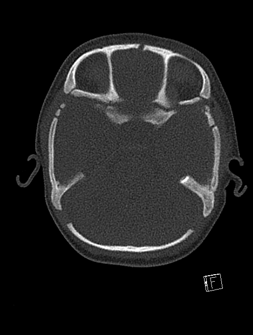 Bilateral subdural hemorrhage and parietal skull fracture (Radiopaedia 26058-26192 Axial bone window 96).png