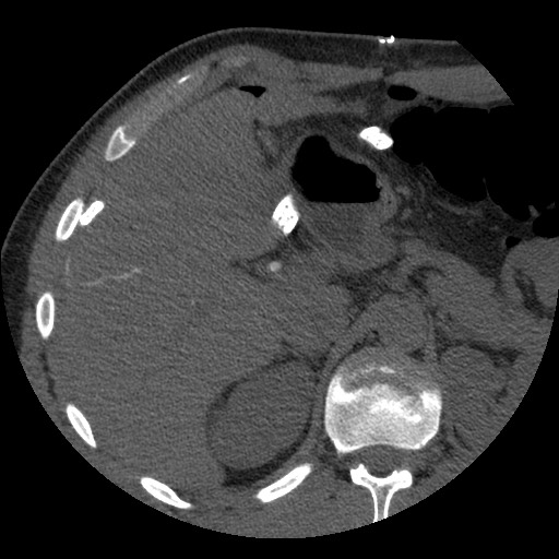 File:Bile leak from liver traumatic laceration (Radiopaedia 63463-72077 Axial Biliscopin 40).jpg