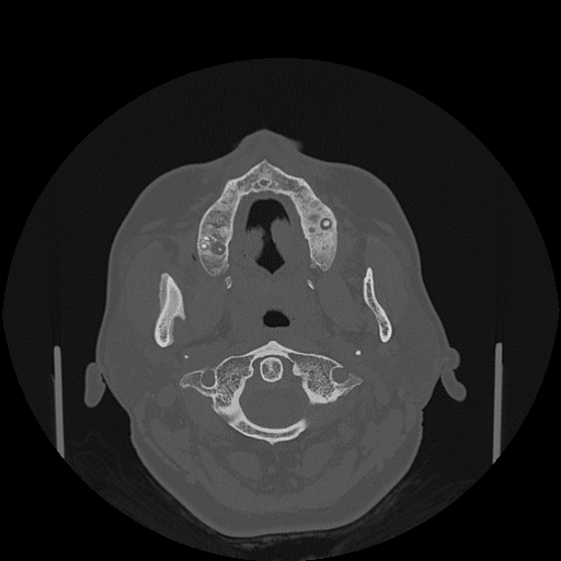 File:Bisphosphonate-related osteonecrosis of the jaw (Radiopaedia 71324-81642 Axial bone window 109).jpg