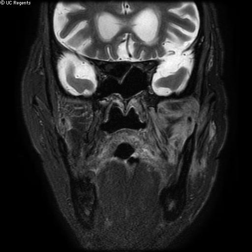 File:Bisphosphonate-related osteonecrosis of the maxilla (Radiopaedia 51367-57101 Coronal T2 fat sat 13).jpg