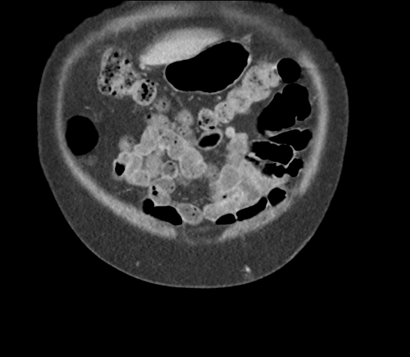 File:Bladder papillary urothelial carcinoma (Radiopaedia 48119-52951 C 11).png