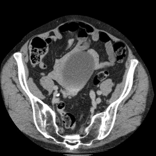 Bladder tumor detected on trauma CT (Radiopaedia 51809-57609 C 105).jpg