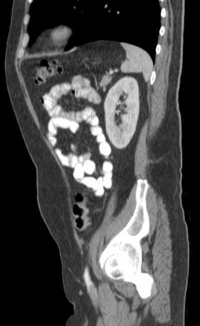 Bleeding duodenal ulcer and adenomyomatosis of gallbladder (Radiopaedia 61834-69861 C 76).jpg