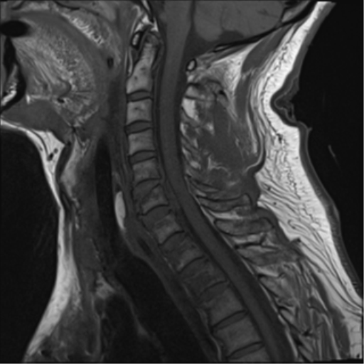 File:Blunt cerebrovascular injury (Radiopaedia 53682-59744 Sagittal T1 8).png