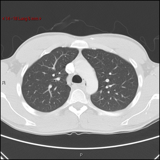 Blunt chest trauma - pulmonary interstitial emphysema and pneumomediastinum (Radiopaedia 20666-20552 Axial lung window 18).jpg