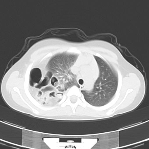File:Bochdalek diaphragmatic hernia (Radiopaedia 38866-41059 Axial lung window 7).jpg