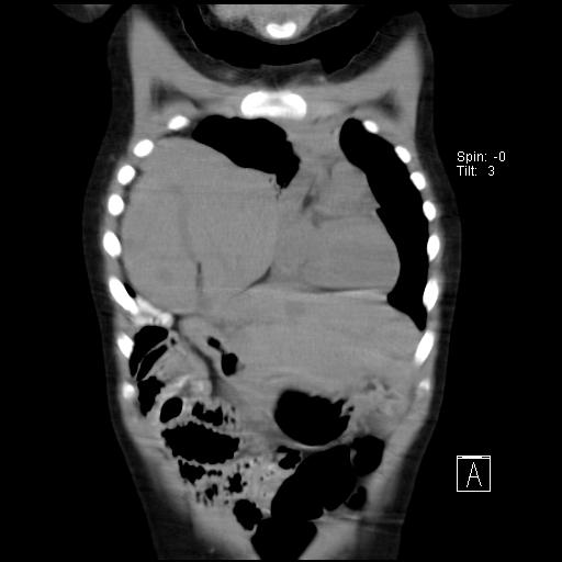File:Bochdalek diaphragmatic hernia (Radiopaedia 38866-41059 Coronal liver window 6).jpg