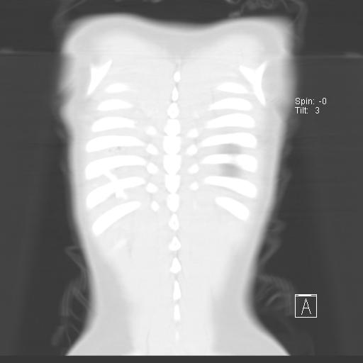File:Bochdalek diaphragmatic hernia (Radiopaedia 38866-41059 Coronal lung window 20).jpg