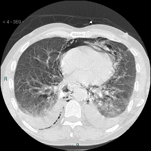 Boerhaave syndrome (Radiopaedia 27683-27897 lung window 68).jpg