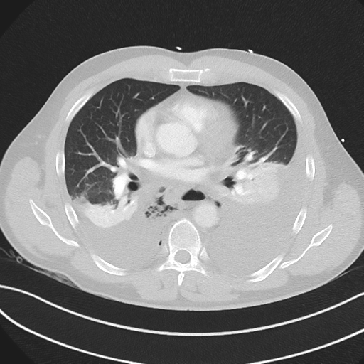 Boerhaave syndrome (Radiopaedia 39382-41660 Axial lung window 29).png