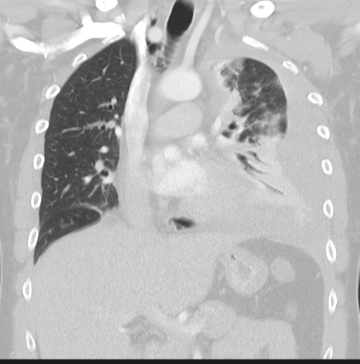 Boerhaave syndrome (Radiopaedia 39382-41661 Coronal lung window 22).png