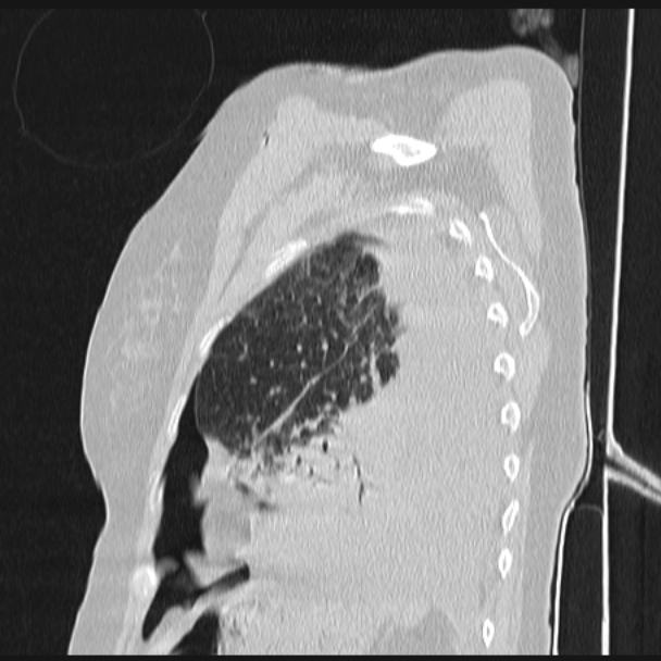 Boerhaave syndrome (Radiopaedia 45644-49799 Sagittal lung window 69).jpg