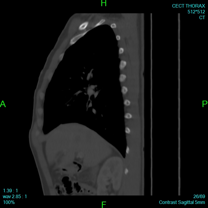 Bone metastases from lung carcinoma (Radiopaedia 54703-60937 Sagittal bone window 26).jpg