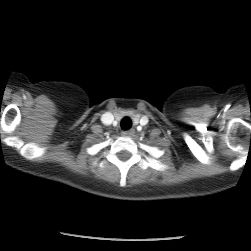 Borderline mucinous tumor (ovary) (Radiopaedia 78228-90808 A 3).jpg