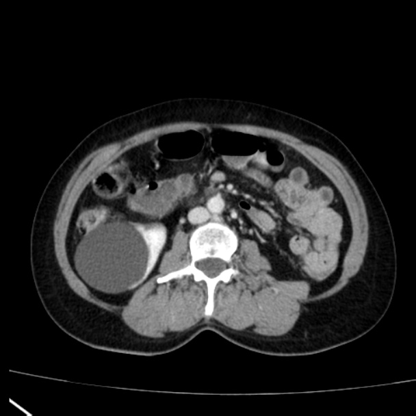 Bosniak renal cyst - type I (Radiopaedia 27479-27675 C 45).jpg