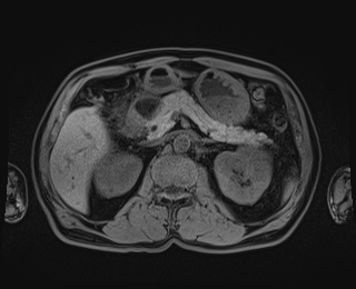Bouveret syndrome (Radiopaedia 61017-68856 Axial T1 fat sat 35).jpg
