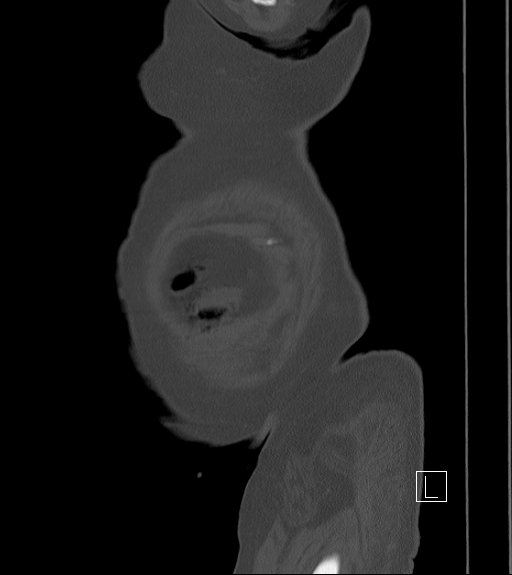 Bowel ischemia secondary to SMA occlusion with extensive portomesenteric venous gas (Radiopaedia 54656-60871 Sagittal bone window 113).jpg