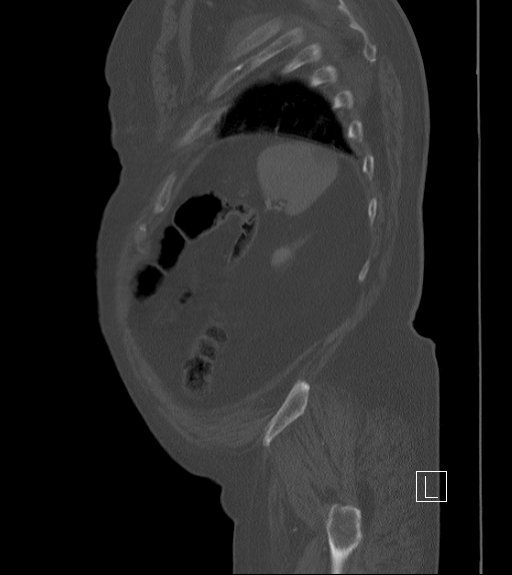 Bowel ischemia secondary to SMA occlusion with extensive portomesenteric venous gas (Radiopaedia 54656-60871 Sagittal bone window 15).jpg