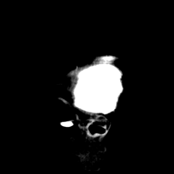 Brain cortical laminar necrosis (Radiopaedia 25822-25971 non-contrast 48).jpg