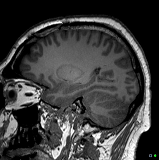 Brain death on MRI and CT angiography (Radiopaedia 42560-45689 Sagittal T1 52).jpg