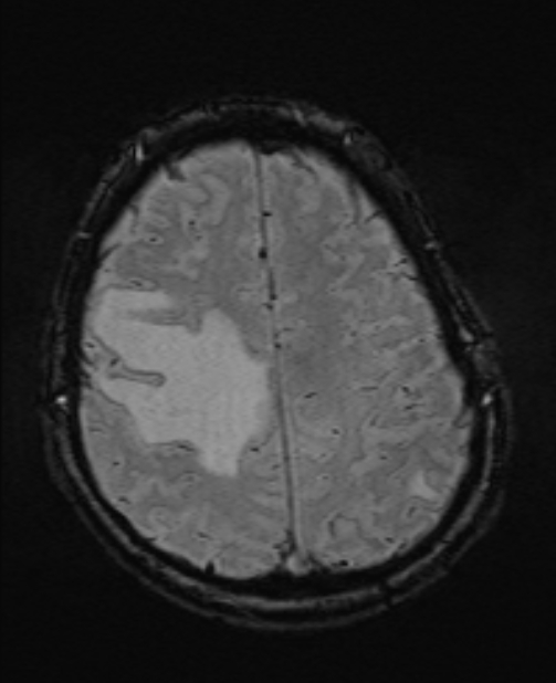 Brain metastases - lung cancer primary (Radiopaedia 75060-86115 Axial SWI 47).jpg