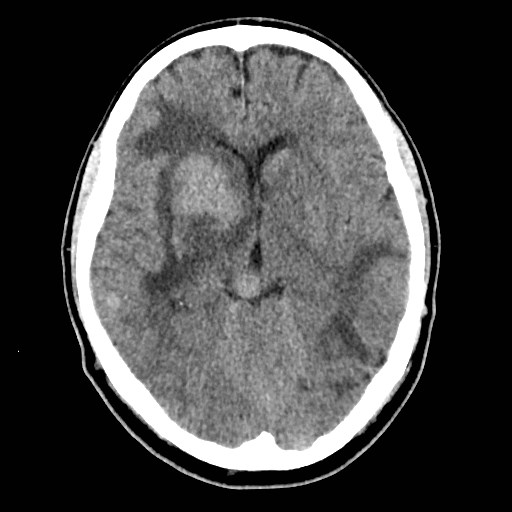 File:Brain metastases from lung cancer (Radiopaedia 83839-99027 Axial non-contrast 16).jpg