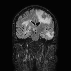 File:Brain metastases from lung cancer (Radiopaedia 83839-99028 Coronal FLAIR 39).jpg