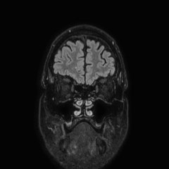 Brain metastases from lung cancer (Radiopaedia 83839-99028 Coronal FLAIR 9).jpg