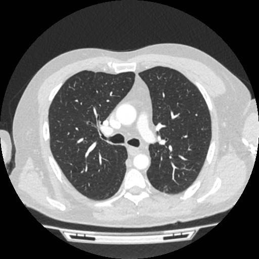 File:Brain metastases from lung cancer (Radiopaedia 83839-99030 Axial lung window 27).jpg