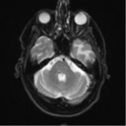 Brain metastasis (large cystic mass) (Radiopaedia 47497-52107 Axial DWI 7).png