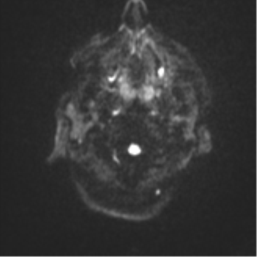 Brain metastasis (sarcoma) (Radiopaedia 47576-52209 Axial DWI 29).png