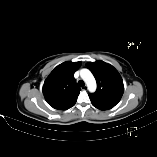 Brain metastasis as initial presentation of non-small cell lung cancer (Radiopaedia 65122-74127 A 15).jpg