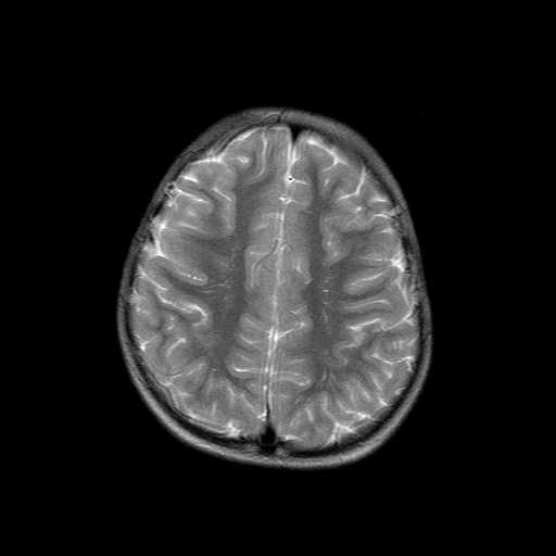 File:Brainstem ganglioglioma (Radiopaedia 10763-11224 Axial T2 5).jpg