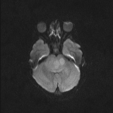 Brainstem glioma (Radiopaedia 67531-76922 Axial DWI 31).jpg