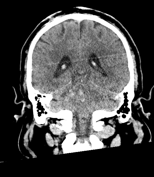 File:Brainstem hemorrhage (Radiopaedia 81294-94976 Coronal non-contrast 45).jpg