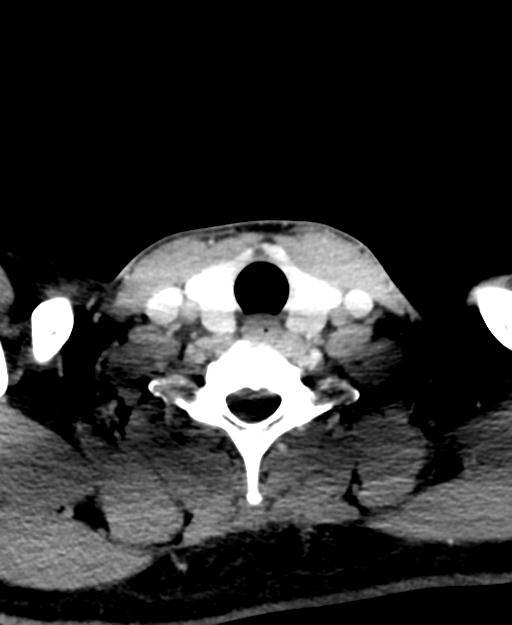 Branchial cleft cyst (Radiopaedia 31167-31875 Axial C+ delayed 52).jpg