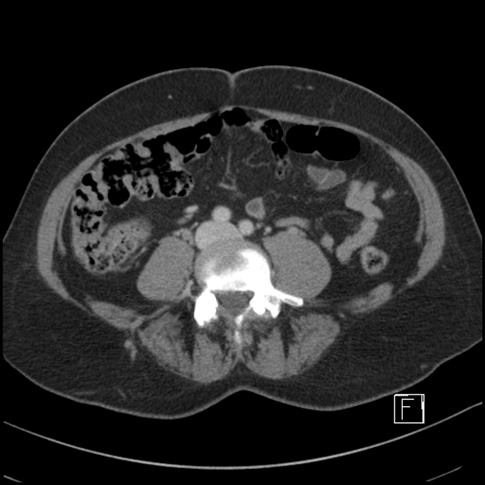 File:Breast metastases from renal cell cancer (Radiopaedia 79220-92225 C 68).jpg