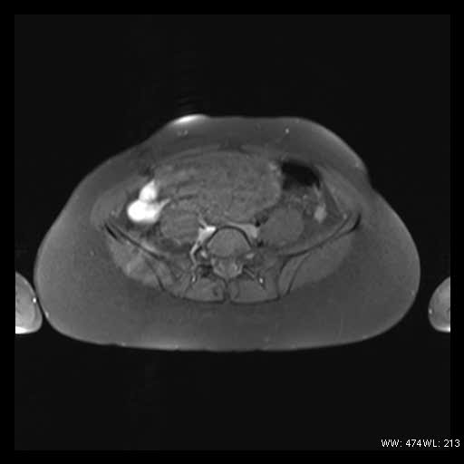 File:Broad ligament fibroid (Radiopaedia 49135-54241 Axial T1 fat sat 8).jpg