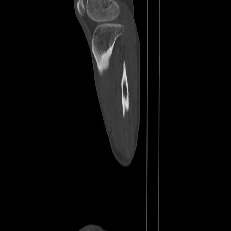 Brodie abscess - tibia (Radiopaedia 66028-75204 Sagittal bone window 64).jpg