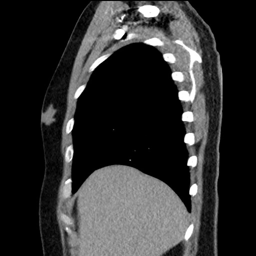 Bronchial carcinoid tumor (Radiopaedia 67377-76764 E 13).jpg