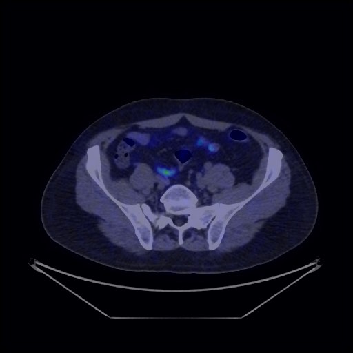 Bronchial carcinoid tumor (Radiopaedia 67377-76765 68Ga-DOTATATE PET-CT 64).jpg