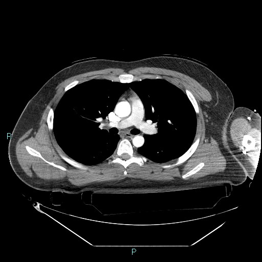 Bronchial carcinoid tumor (Radiopaedia 78272-90870 B 53).jpg