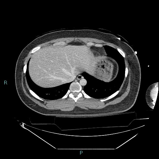 Bronchial carcinoid tumor (Radiopaedia 78272-90870 C 99).jpg